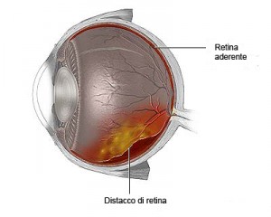 Salute: Antibiotici aumentano il rischio del distacco di retina