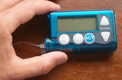 Tecnologia contro il diabete: come funziona il Microinfusore Insulinico