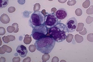Una proteina contro la leucemia infantile
